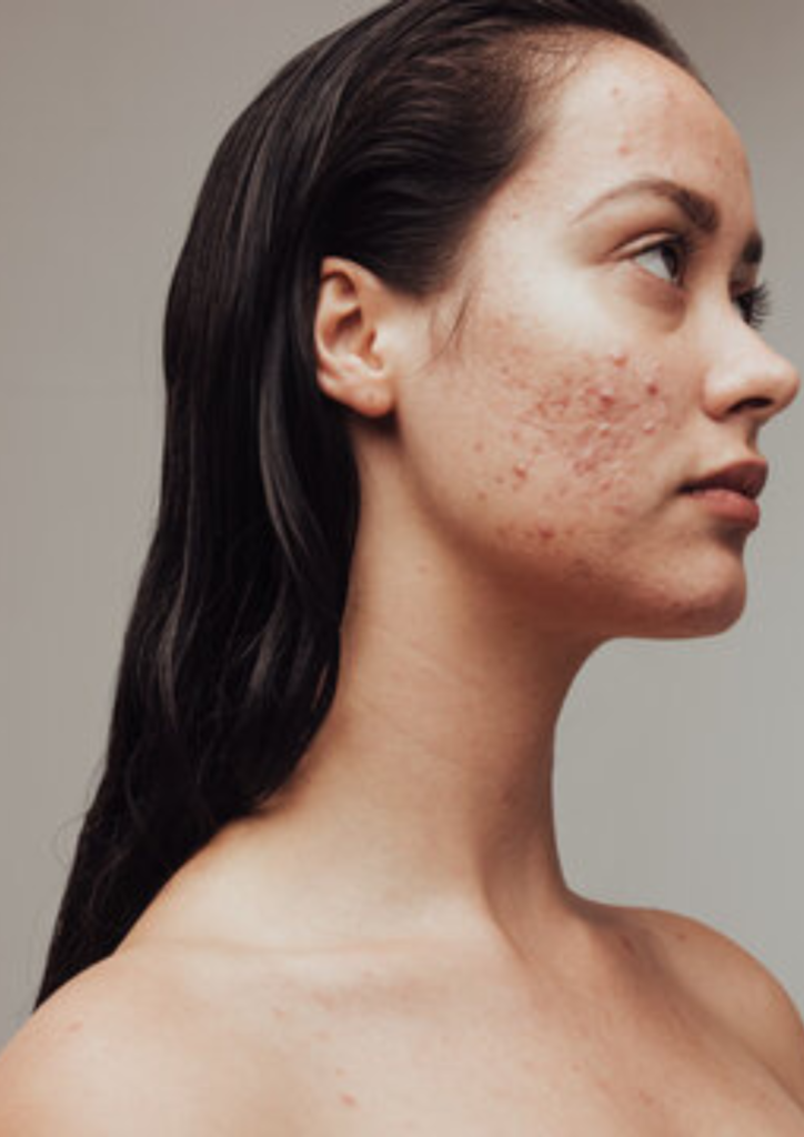 Acne vulgaris