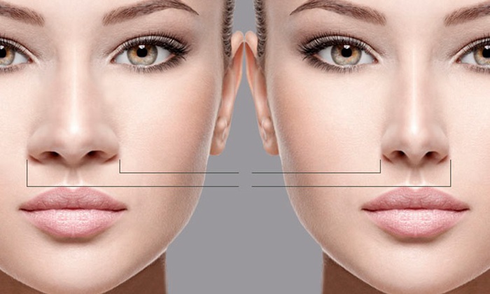 Non-surgical nose reshaping at Waho Aesthetics