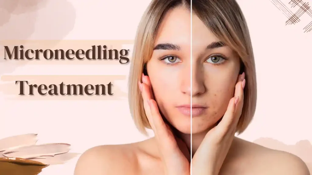 Microneedling Skin Treatment in Dubin