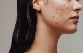 Acne vulgaris